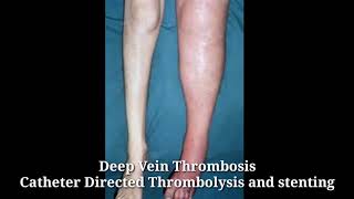 Deep Vein Thrombosis DVT  Treatment Catheter Directed Thrombolysis and stenting in Hyderabad [upl. by Enaile798]