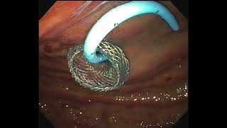 Acute worsening of gastric outlet obstruction following EUSguided gastrojejunal bypass [upl. by Cumings813]