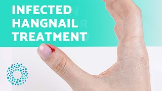 HOW to TREAT an INFECTED HANGNAIL 😟 Get Rid of Hangnails Easily [upl. by Harneen]