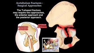 Acetabulum Fractures Surgical Approaches  Everything You Need To Know  Dr Nabil Ebraheim [upl. by Alrep277]