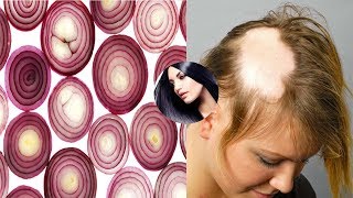 Grandmas SECRET Recipe for Hair growth in 15 days Onion Juice And Coconut Oil Pack treatment [upl. by Mariel836]