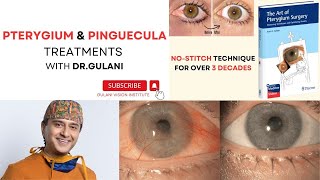 Pinguecula Treatments and Pterygium Treatments GulaniVision [upl. by Noiz164]