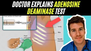 Doctor explains Adenosine Deaminase test  Tuberculosis TB [upl. by Linette70]