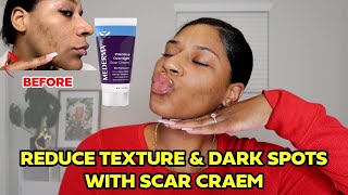 Mederma Cream for Acne Scars  My 2 Week Transformation [upl. by Thornton]