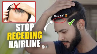 7 Tips to Stop Receding Hairline  Receding Hairline Regrowth  SAHIL [upl. by Samuele564]