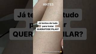 Instagram queratosepilar 📌 queratosepilar keratosispilaris insulina diabetes doces [upl. by Odnama]