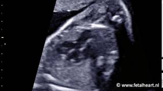 Fetal heart Academy  Tetralogy of Fallot 1 LVOT [upl. by Snah810]