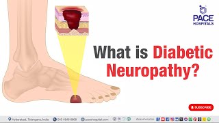 Diabetic Neuropathy  What is Diabetic Neuropathy  diabeticneuropathy [upl. by Redneval]