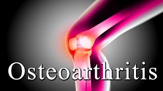 Osteoarthritis Treatment  Knee amp Hip  Natural Ayurvedic Home Remedies for Knee Osteoarthritis [upl. by Aicargatla]