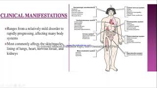 Systemic Lupus Erythematosus SLE [upl. by Muhan927]