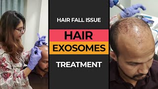 Exosomes Treatment for Hair Fall Issue  HASH CLINICS [upl. by Eahc620]