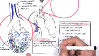 PART I  Pneumonia Overview Lobar and Bronchopneumonia [upl. by Nrehtak]