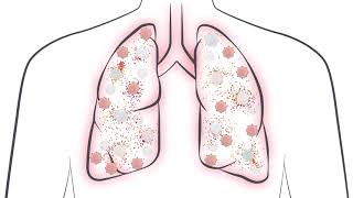 See how a Cytokine Storm can impact COVID19 patients What do IL6 levels tell you [upl. by Nie700]