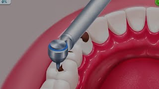 Removal Of Tonsil Stones  ASMR Dental Cleaning Procedure  ASMR Oral Health Dental Treatment [upl. by Smoot]