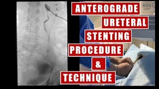 Transnephrostomy Ureteral Stent placement under fluoroscopy guidance procedure and technique [upl. by Delano]