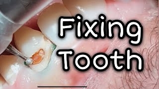 How to fix cavities in front teeth  Dental ASMR [upl. by Hirasuna]