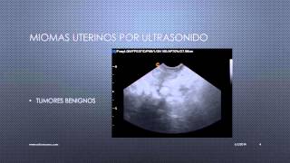 MIOMAS UTERINOS VISUALIZADOS POR ULTRASONIDO [upl. by Shaylynn6]