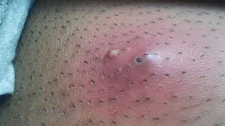 Ingrown hair under arm pit‼️ so many hairs trapped 😱 [upl. by Kassie967]