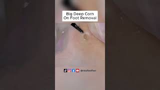 Extreme Big Deep Corn On Foot Removal Full Treatment By Miss Foot Fixer [upl. by Jenkel276]