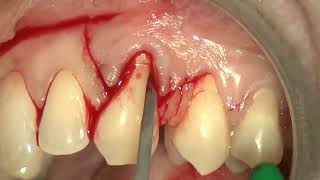 9 Multiple bilaminar technique with single vertical releasing incision in the upper jaw [upl. by Adla]