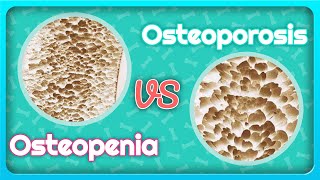 Osteoporosis vs Osteopenia Whats the Difference [upl. by Urbain]