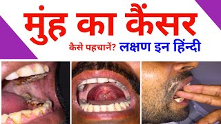 मुहं के कैंसर के लक्षण oral fibrosis Cancer  मुहं के कैंसर के शुरुआती लक्षण  muh ka cancer [upl. by Asalocin995]