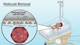 Peritoneal Dialysis by S Su A Olszewski  OPENPediatrics [upl. by Groome]