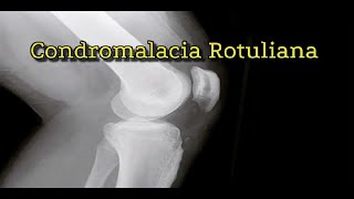 🤕Condromalacia Rotuliana💉 [upl. by Fara]