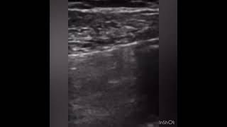 Lung Sliding sign on POCUS [upl. by Gustavus]