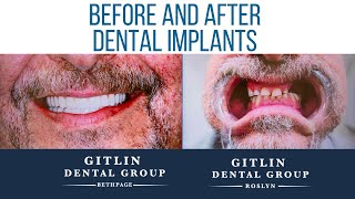 AllonX Dental Implants Experience at Gitlin Dental Group [upl. by Dnar]