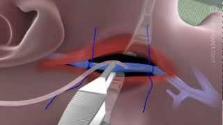 Proper Technique for Internal Jugular Cannulation [upl. by Ideih]