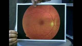 Fundoscopy 4  Retina [upl. by Bajaj]