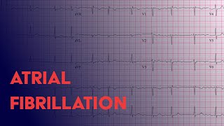 Atrial Fibrillation Afib  EKG ECG Interpretation [upl. by Iturhs]