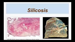 Silicosis [upl. by Miahc681]