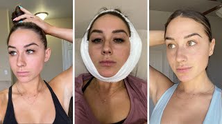 I GOT PLASTIC SURGERY  MY OTOPLASTY EXPERIENCE [upl. by Vona]