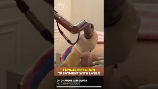 Fungal infection treatment with laser By Dr Chandni Jain Gupta shorts [upl. by Tarrsus]