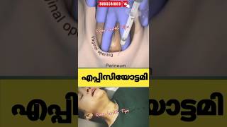 പ്രസവസമയത്ത് episiotomy ചെയ്യുന്നത്pregnancy education malayalam [upl. by Hentrich]