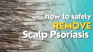 Do Not Scratch Psoriasis or Dermatitis  Do This Instead wwwmyhappyscalpcom [upl. by Nnayar]