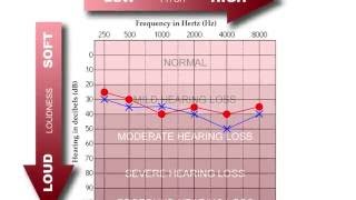 How to Read an Audiogram [upl. by Lovato]