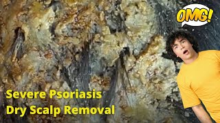 Removal of SEVERE Psoriasis Seborrheic Dermatitis Dry Scalp amsr [upl. by Josias]