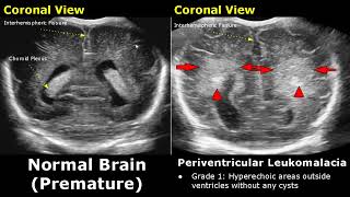 Neonatal Brain Ultrasound Normal Vs Abnormal Images  Full Term Infant amp Premature Newborn Head USG [upl. by Asilak359]