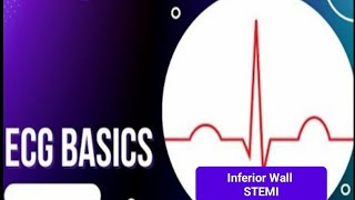 ECG Basics  Inferior wall STEMI [upl. by Roma]