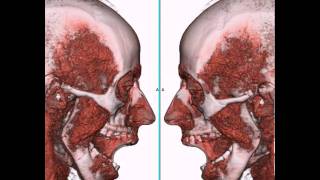 Articulación Temporo Mandibular ATM a través de TC 4D [upl. by Henrietta]