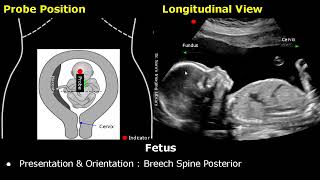 Obstetric Ultrasound Probe Positioning  Pregnant Uterus amp Fetus Transducer Placement USG Scan [upl. by Haynes358]