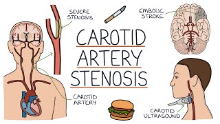 Understanding Carotid Artery Stenosis [upl. by Richma149]