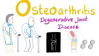 Osteoarthritis OA  Introduction  Rheumatology Series [upl. by Wellington]