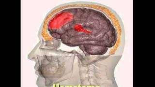 Como Se Lesiona el Cerebro Una Fuerza Positiva Modulo 3 [upl. by Bonina]