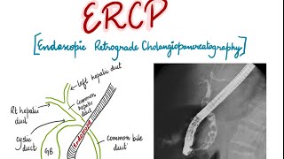 ERCP Endoscopic Retrograde Cholangiopancreatography presentation for medical students [upl. by Huber]