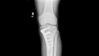 Fratura Planalto Tibial Osteotomia Valgizante Joelho evolução Clínica Fisioterapia Dr Robson Sitta [upl. by Earas439]