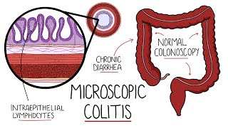 Microscopic Colitis Lymphocytic amp Collagenous Colitis  An Underdiagnosed Form of IBD [upl. by Ryle]